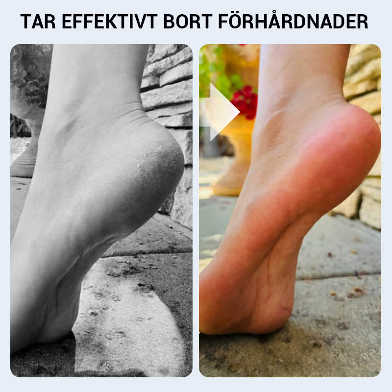🔥 ﻿Практичен ръчен инструмент за премахване на мазоли по краката🦶🏻